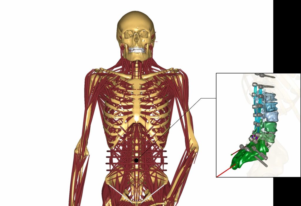 Spine implant, prosthesis, simulation, software, analysis